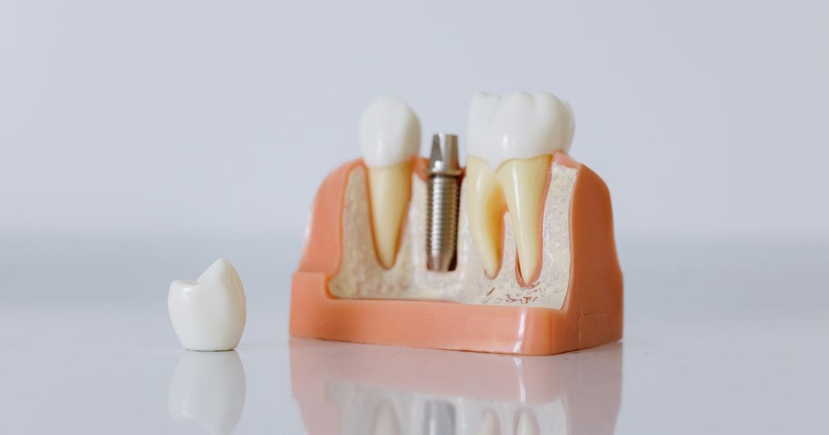How Much Do Dental Implants Cost in Denver?