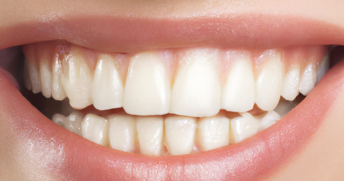 Teeth Whitening in Denver: Your Options and What They Cost